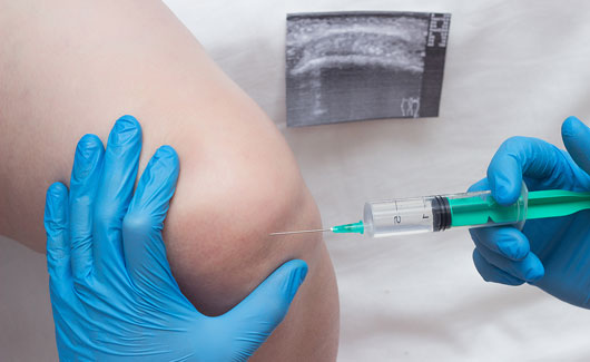 Nahaufnahme der Injektion von Hyaloronsäure in ein Knie