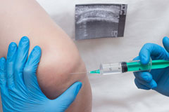 Nahaufnahme der Injektion von Hyaloronsäure in ein Knie